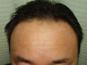 施術前