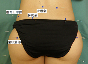 局所治療1