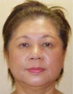 施術前