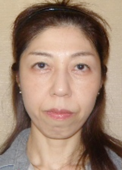 施術前