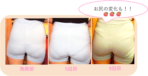 骨盤矯正　ヒップアップ　月経痛　卵巣嚢腫　子宮筋腫　不妊症　美尻　桃尻