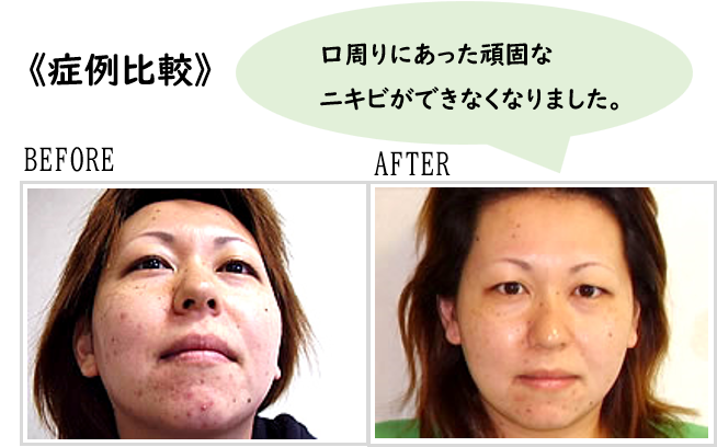 ニキビ鍼灸治療で口周りにあった頑固な ニキビができなくなりました。