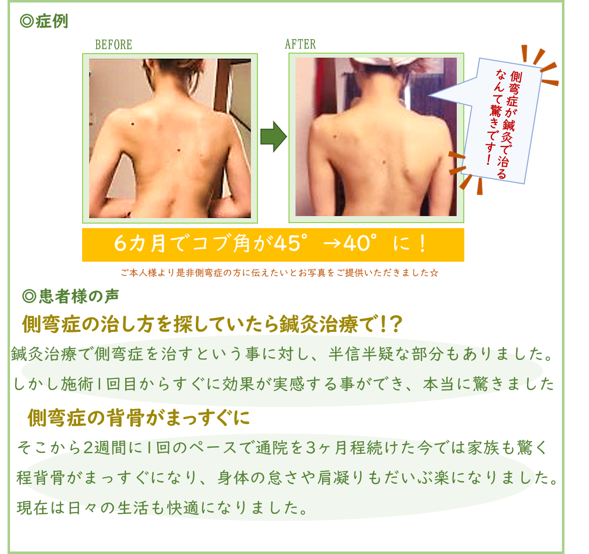 側弯症手術なしでコブ角が45°から40°に！ 側弯症が鍼灸で治るなんて 驚きです！！ 患者様の声 側弯症の治し方を探していたら鍼灸治療で！？ 　鍼灸治療で側弯症を治すという事に対し、半信半疑な部分もありました。　しかし施術1回目からすぐに効果が実感する事ができ、本当に驚きました 側弯症の背骨がまっすぐに 　そこから2週間に1回のペースで通院を3ヶ月程続けた今では家族も驚く 　程背骨がまっすぐになり、身体の怠さや肩凝りもだいぶ楽になりました。 　現在は日々の生活も快適になりました。