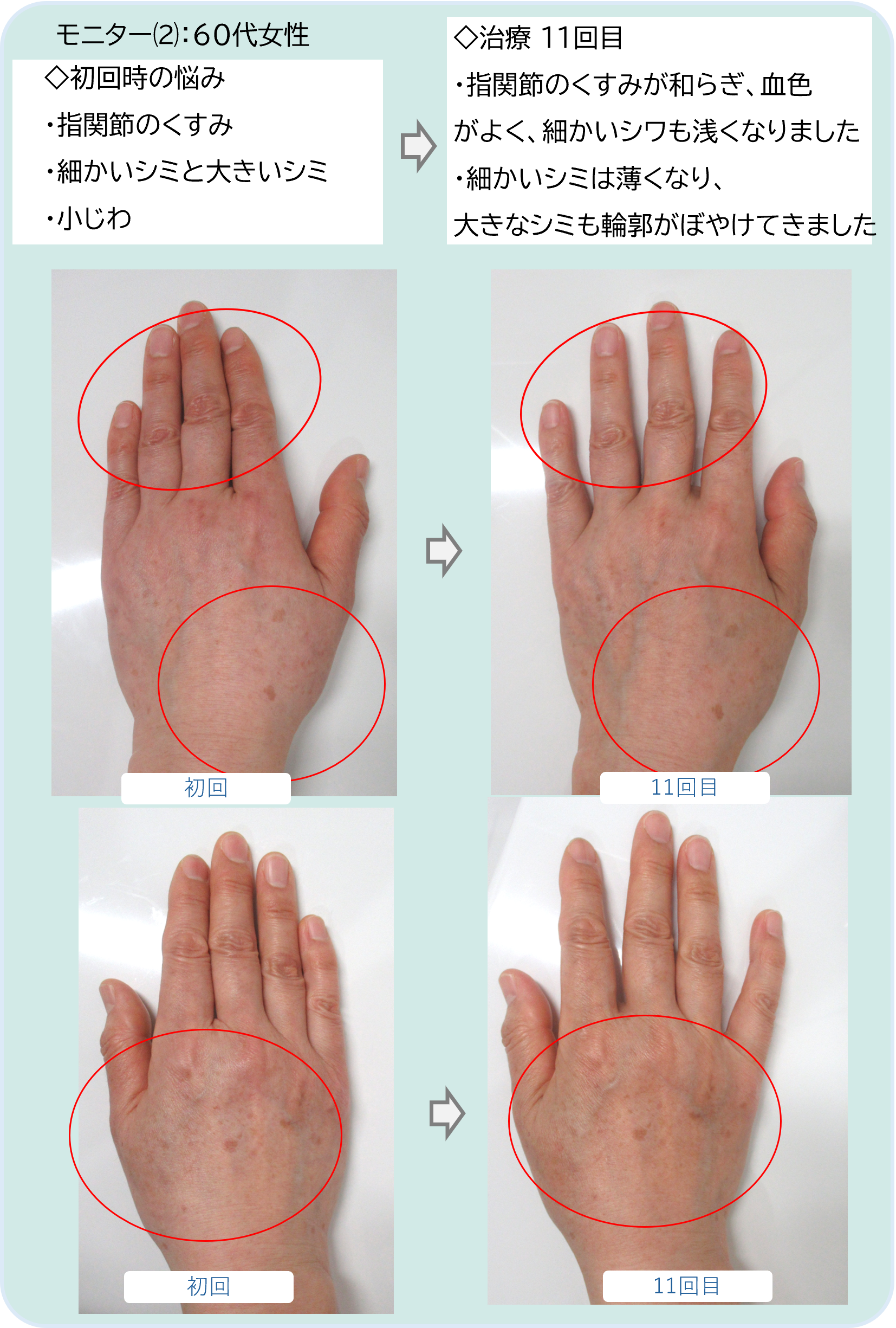 モニター⑵：60代女性
◇初回時の悩み
・細かいシミと大きいシミ
・指関節のくすみ
・小じわ
◇治療 １１回目
・指関節のくすみが和らぎ、血色
がよく、細かいシワも浅くなりました
・細かいシミは薄くなり、
大きなシミも輪郭がぼやけてきました
