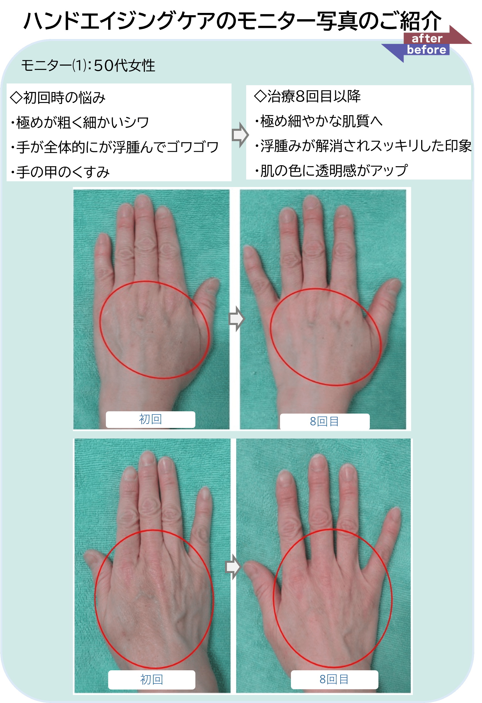 モニター⑴：50代女性
◇初回時の悩み
・極めが粗く細かいシワ
・手が全体的にが浮腫んでゴワゴワ
・手の甲のくすみ
◇治療8回目以降
・極め細やかな肌質へ
・浮腫みが解消されスッキリした印象
・肌の色に透明感がアップ
