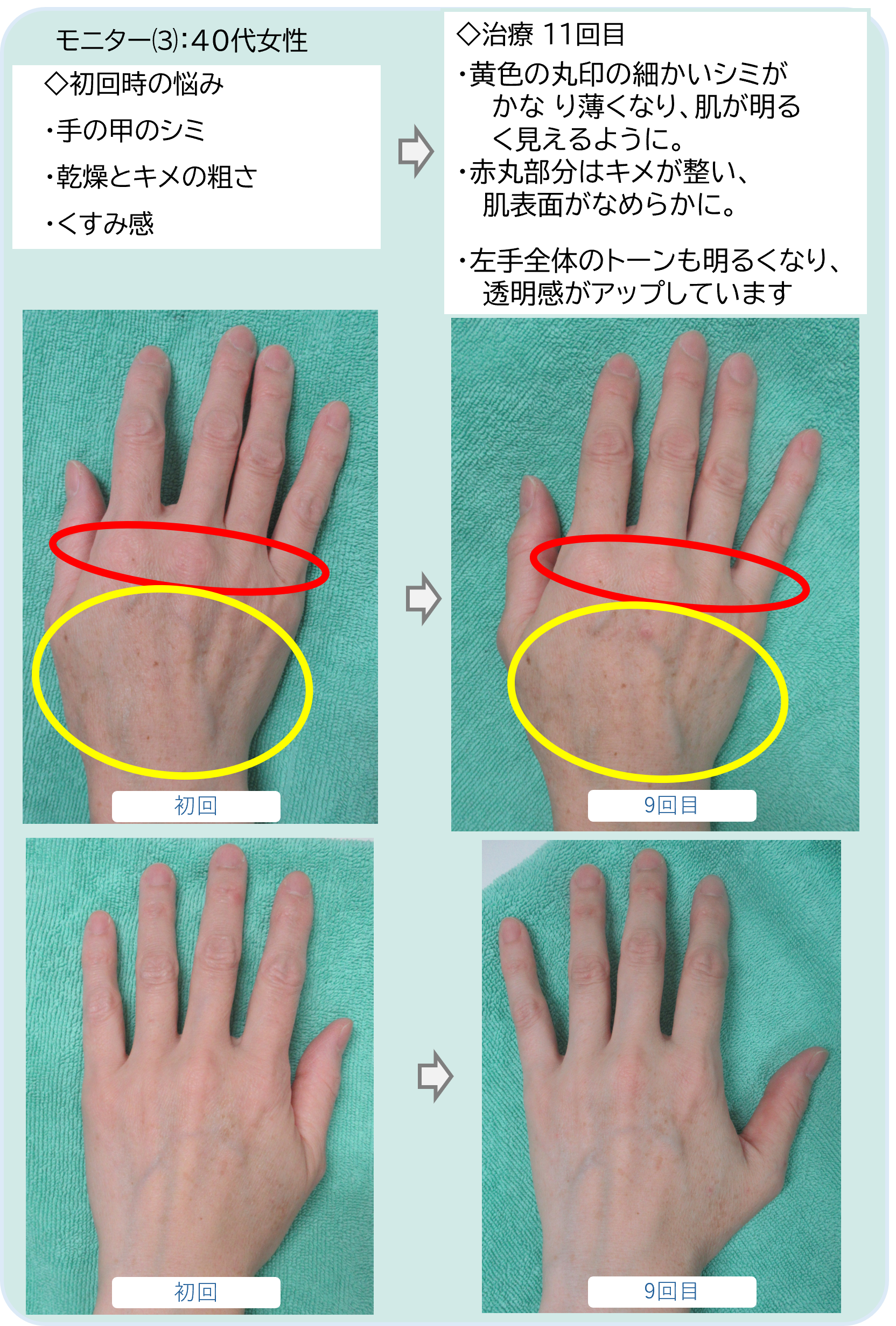 モニター⑶：40代女性
◇初回時の悩み
・手の甲のシミ
・乾燥とキメの粗さ
・くすみ感
◇治療 １１回目
・黄色の丸印の細かいシミが
    かな り薄くなり、肌が明る
    く見えるように。
・赤丸部分はキメが整い、
   肌表面がなめらかに。

・左手全体のトーンも明るくなり、   
   透明感がアップしています
